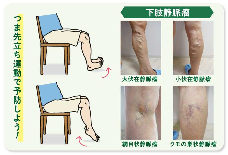 医療 福祉 カラダのお悩み相談室 病院を受診したら 下肢静脈瘤の疑いがあると言われました 下肢静脈瘤ってどんな病気なんですか ながさきプレスwebマガジン 長崎のタウン情報誌公式サイト